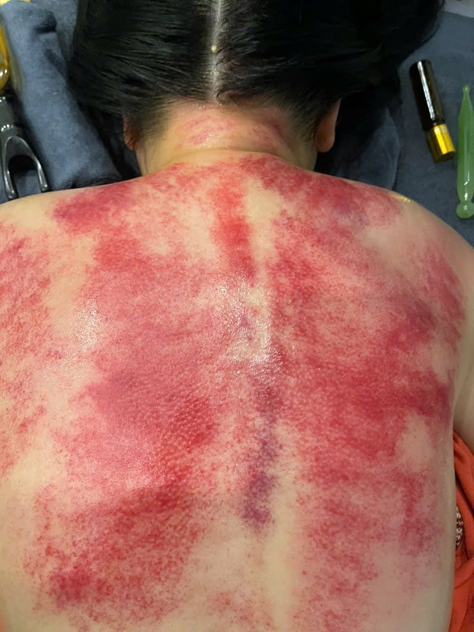 Trị liệu cạo gió, giác hơi thải độc tại Hồi Xuân Đường